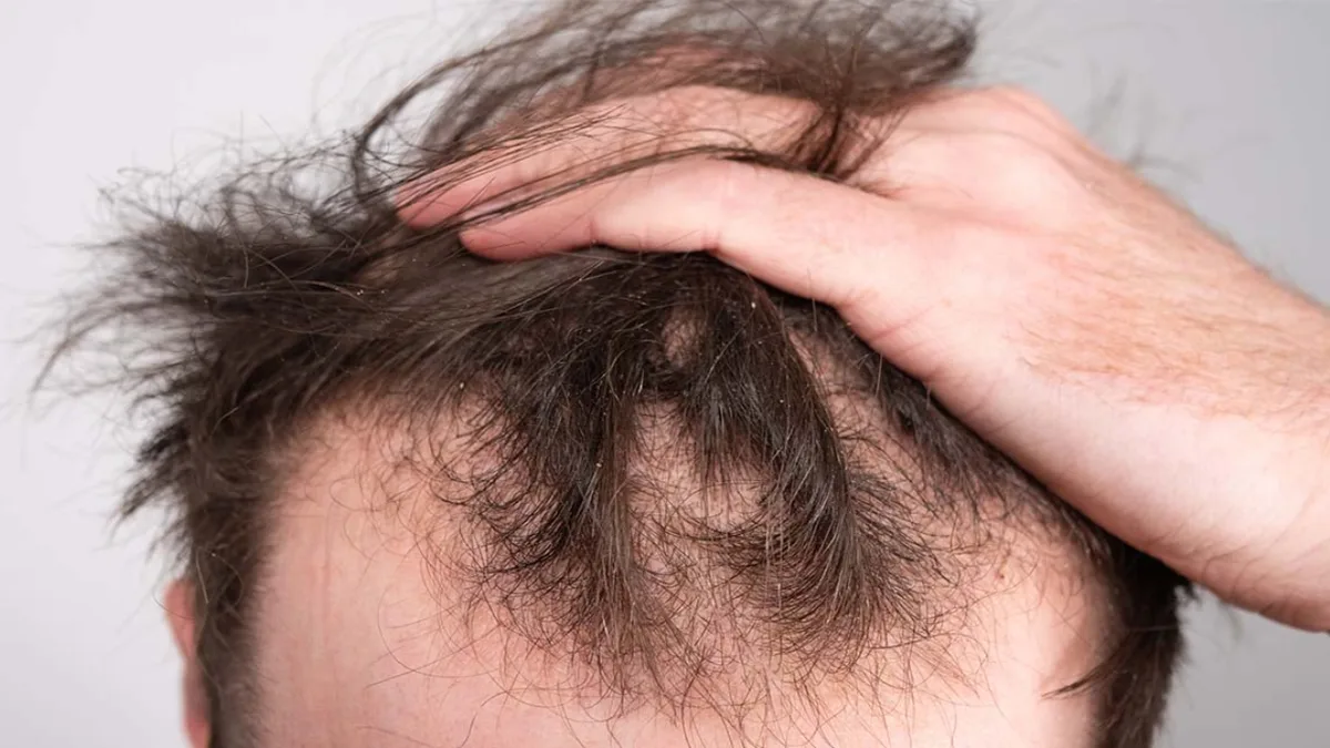 Chau a la calvicie: el azúcar natural que hace crecer el cabello y sorprende a la ciencia
