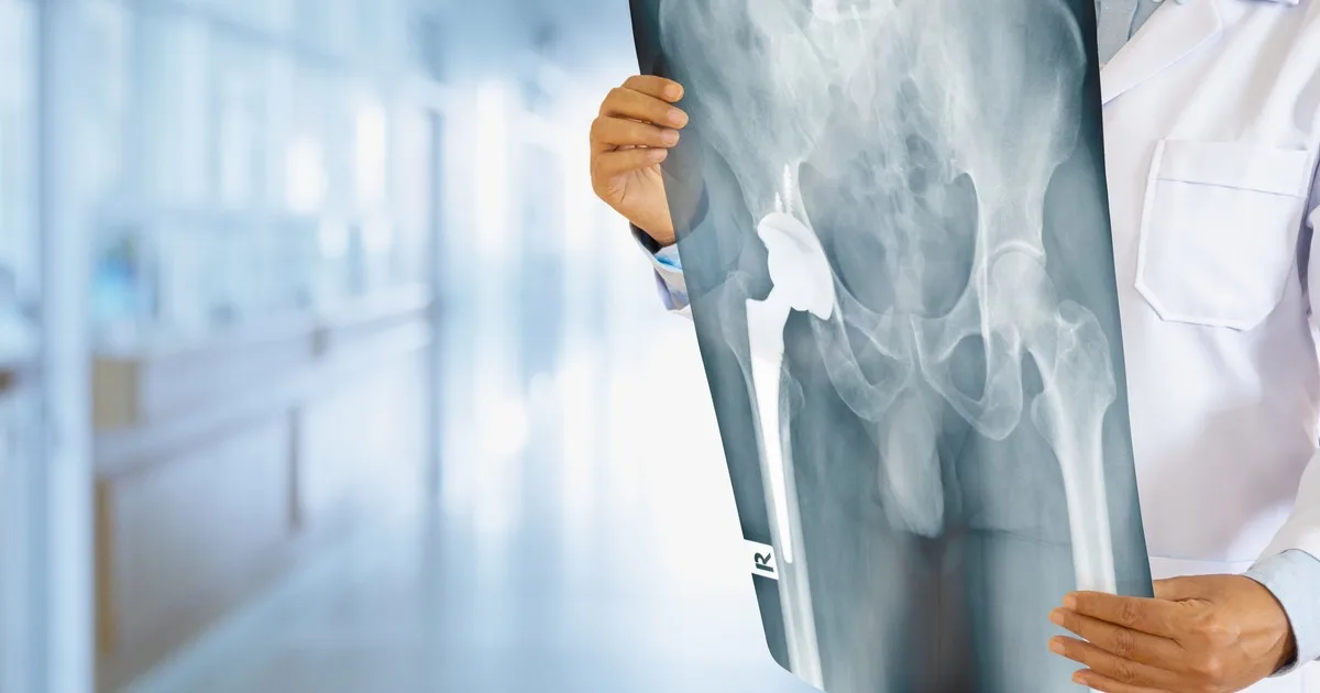 Un fármaco experimental revierte la osteoartritis en semanas, según pruebas en animales